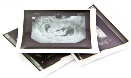 Destacada ecografia 12 semanas_Blogdelbebe